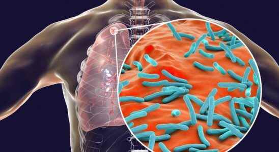 Tuberculosis more than 250 children in contact with an infected