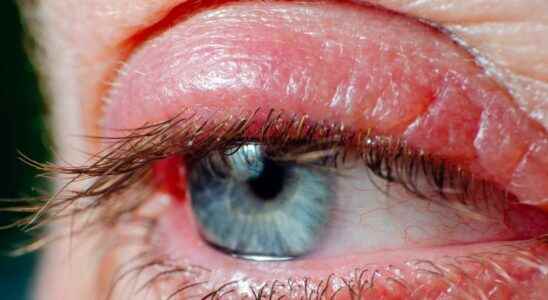 Blepharitis what is it