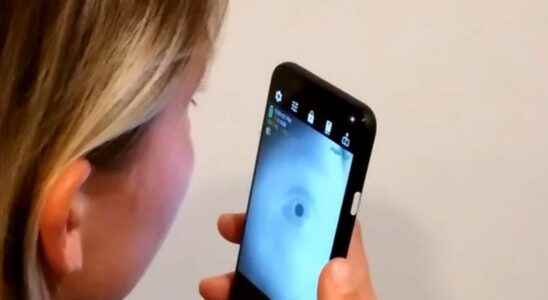 Eye selfies an application could soon detect Alzheimers disease and