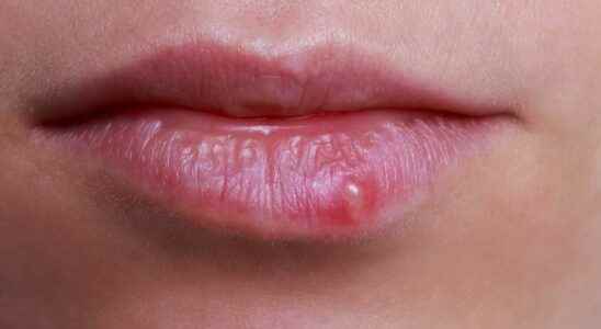 How to differentiate between a herpes labialis pimple and an