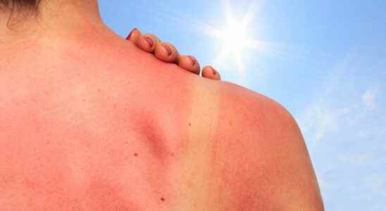How to treat a sunburn