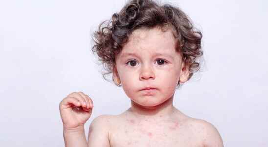 Measles epidemic alert what are the symptoms