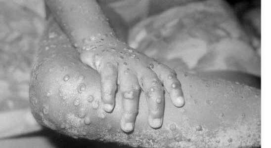 Monkeypox virus The cases may increase but there is no