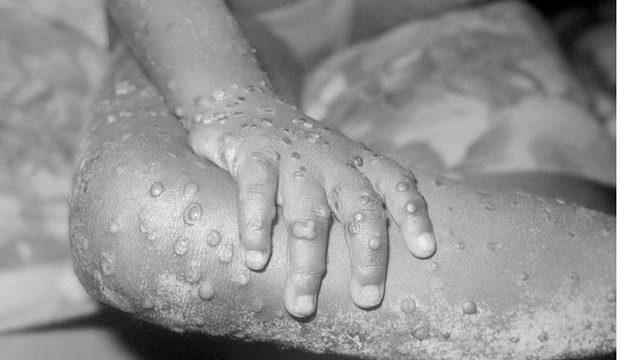 Monkeypox virus The cases may increase but there is no