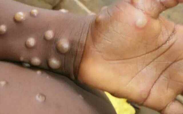 Monkeypox virus alarm in Europe After England it was also