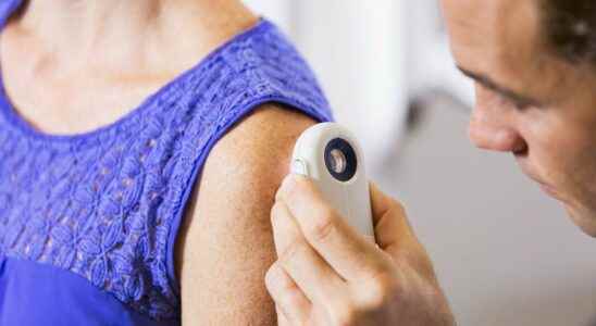 Skin cancer more than 7 million Europeans affected a majority