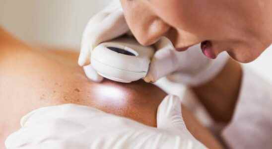 Skin cancer one in five people could be affected in