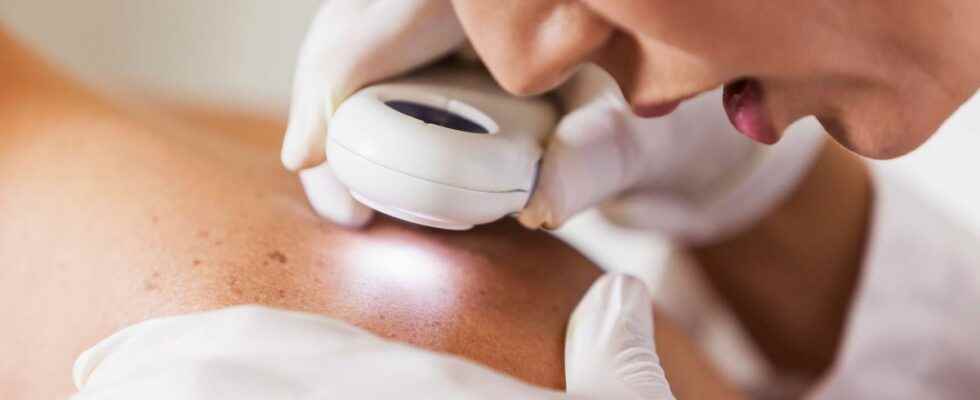 Skin cancer one in five people could be affected in