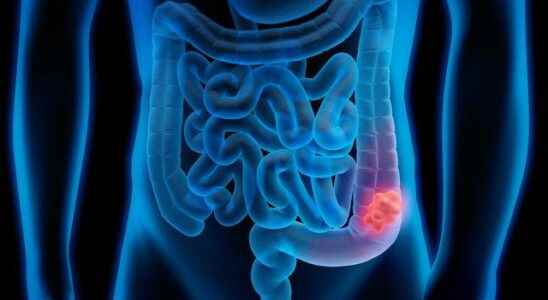 Think twice before you eat Causes colon cancer