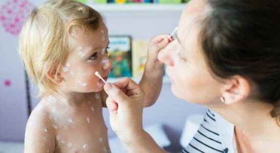 What is good for chickenpox Home treatment can be supported