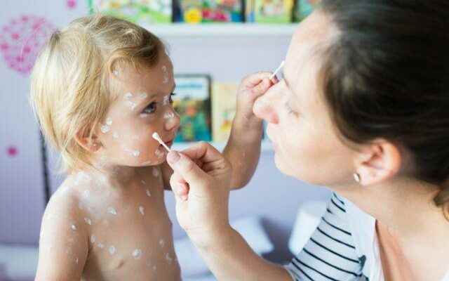 What is good for chickenpox Home treatment can be supported