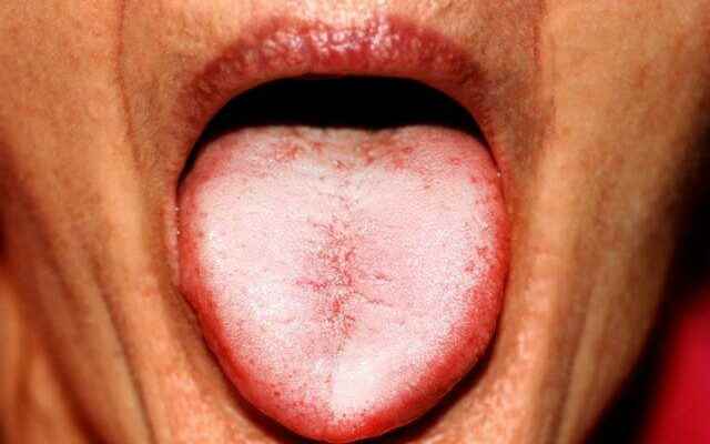 What is good for dry mouth The method that eliminates