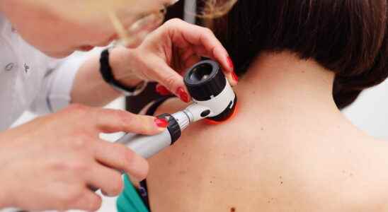 6 warning signs of skin cancer