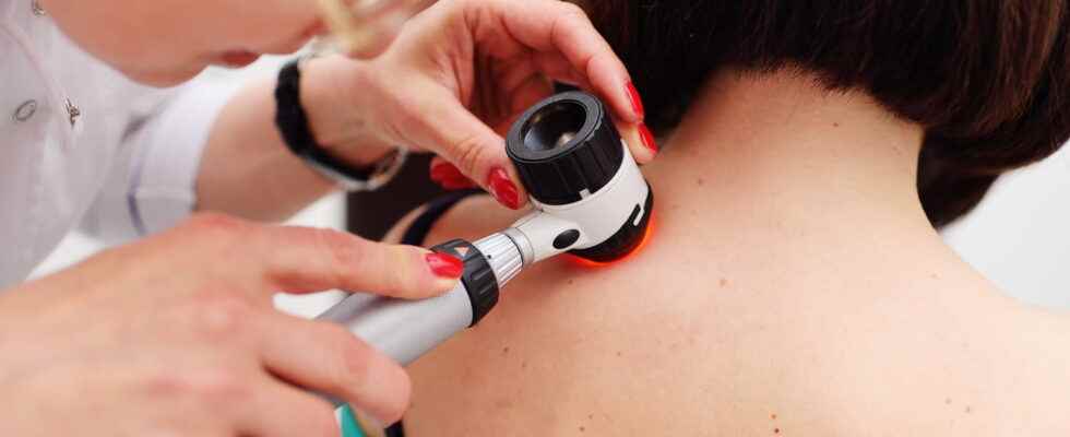 6 warning signs of skin cancer