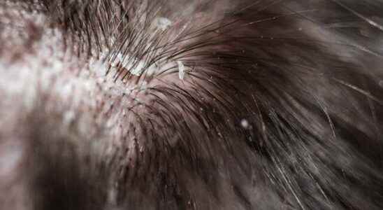 A radical solution to the problem of dandruff in the