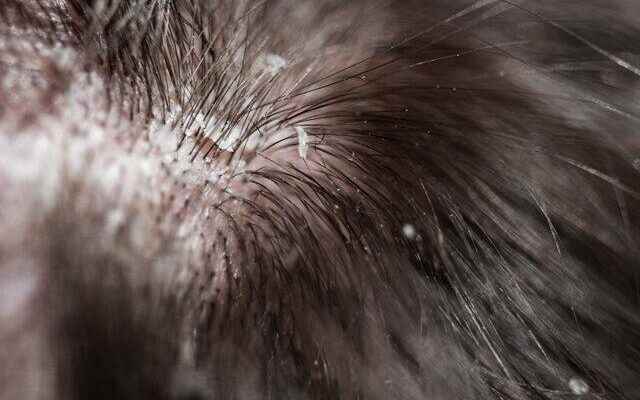 A radical solution to the problem of dandruff in the