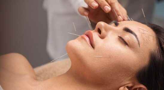 Acupuncture may reduce headaches