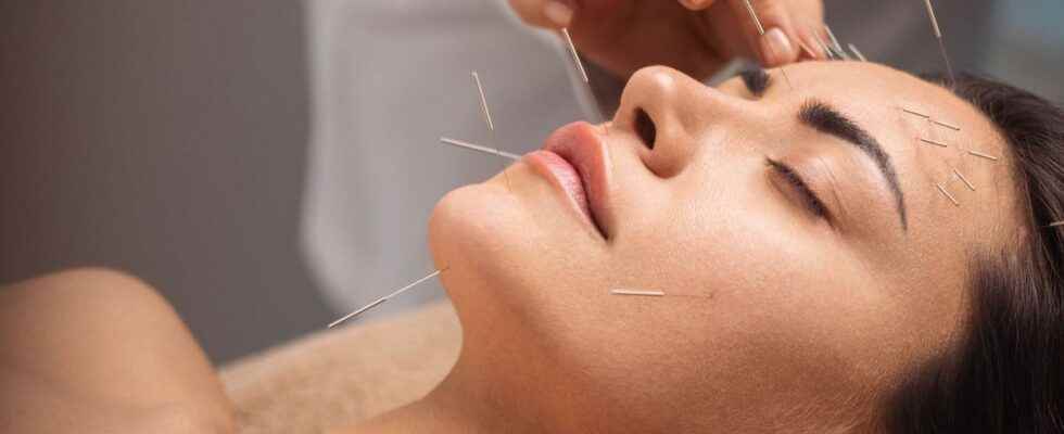 Acupuncture may reduce headaches