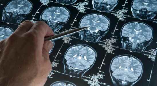 Early Alzheimers a simple MRI allows a diagnosis in 12