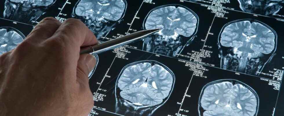 Early Alzheimers a simple MRI allows a diagnosis in 12