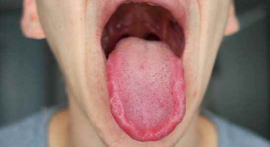 End your pain To treat tongue sores