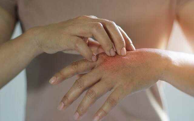 Good news for psoriasis patients Do not think that there