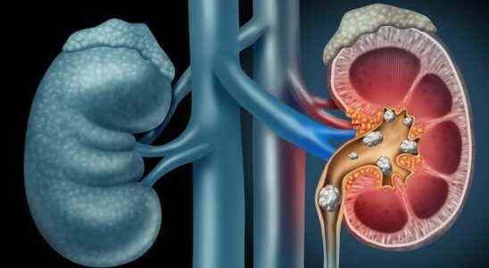 It causes kidney failure Pay attention to its symptoms