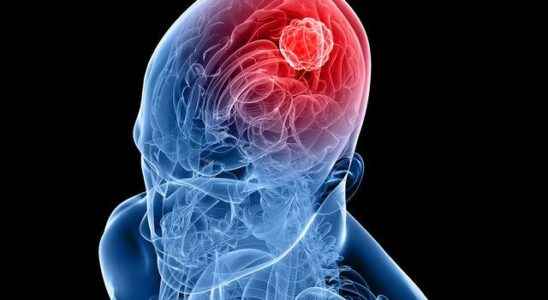It started to be implemented in Turkey Pinpoints brain tumor