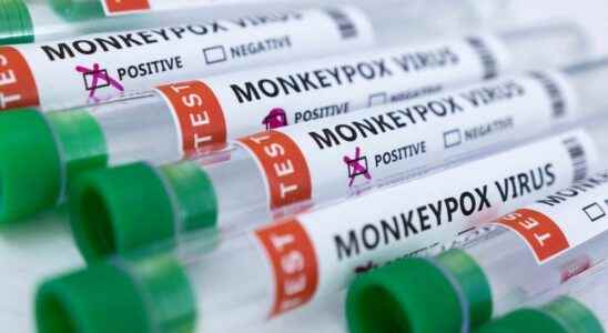 Monkeypox case reported in Norfolk