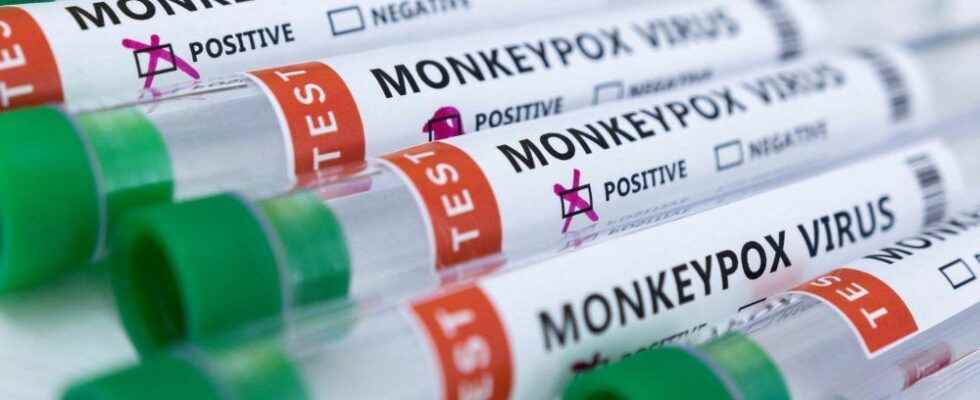 Monkeypox case reported in Norfolk