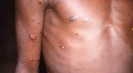 Monkeypox virus the number of cases in the UK rises