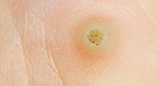 Plantar wart what is it