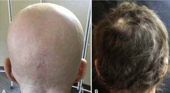 Staying bald is history FDA approved drug gives hope to millions