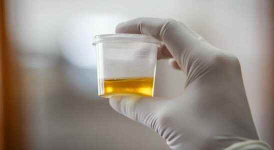 The color of your urine gives an important clue about