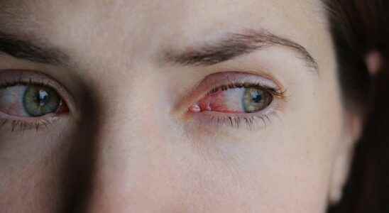 Vernal keratoconjunctivitis what is it