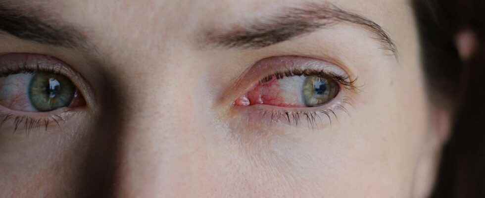 Vernal keratoconjunctivitis what is it