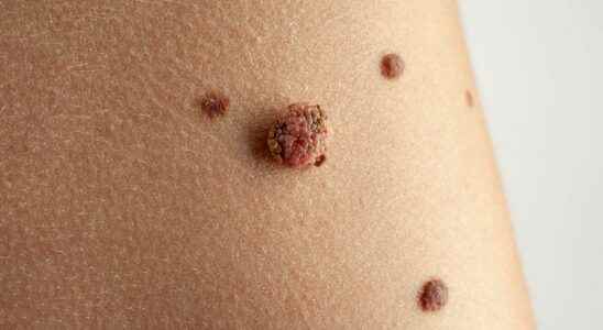 What is the difference between carcinoma and melanoma