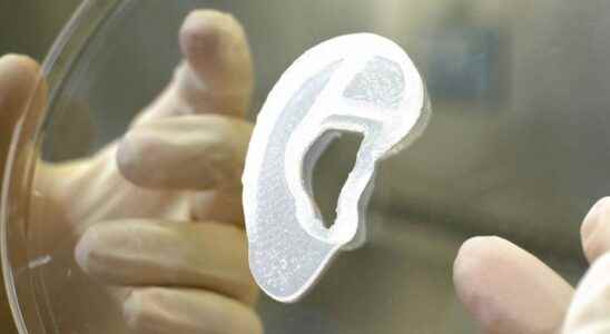 Worlds first human ear implant transplant created by 3D printer