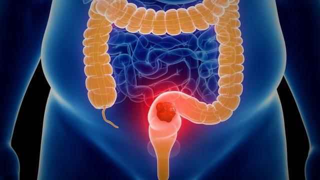Bowel cancer can start in the colon (large intestine) or rectum and is also known as colorectal cancer.
