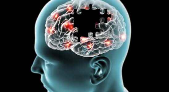 Alzheimers could a blood transfusion rejuvenate the brain