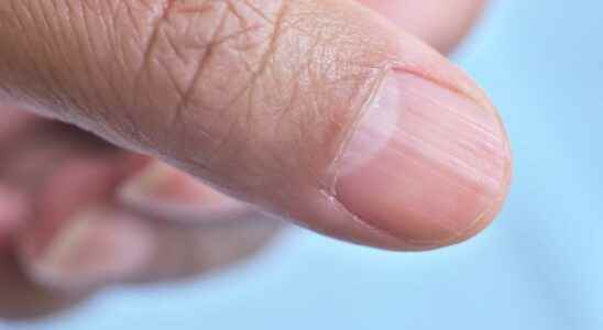 Bizarre patient a strange disease that causes fingernails and toenails