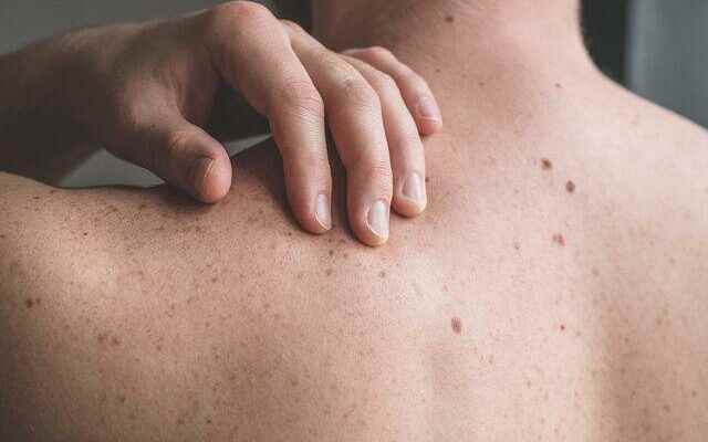 Experts warn Pay attention to the appearance of your moles