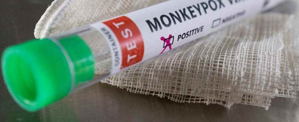 Health unit reports first confirmed case of monkeypox in Brant
