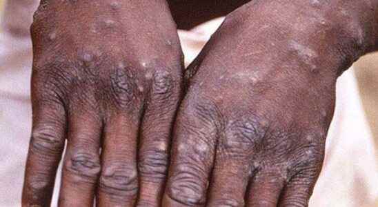 How many people died from monkey pox Statement from the