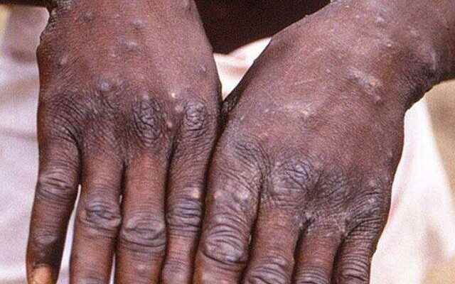 How many people died from monkey pox Statement from the