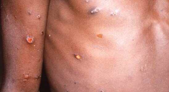 It is not excluded that monkeypox will become more contagious