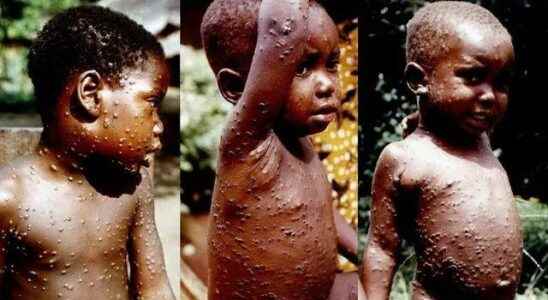 Monkey pox nightmare in the USA Spreading First seen in