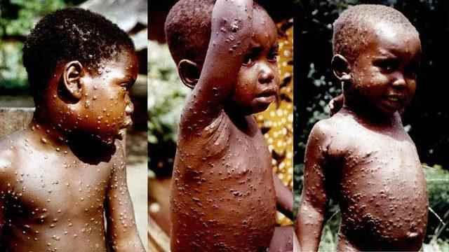 Monkey pox nightmare in the USA Spreading First seen in