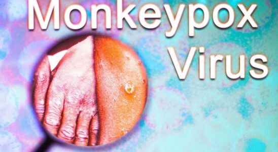 Monkey pox recognizing lesions and general symptoms