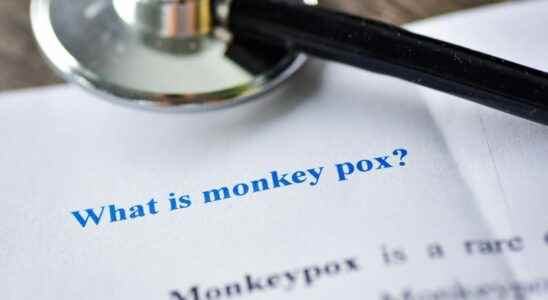 Monkey pox symptoms not always identical in all patients